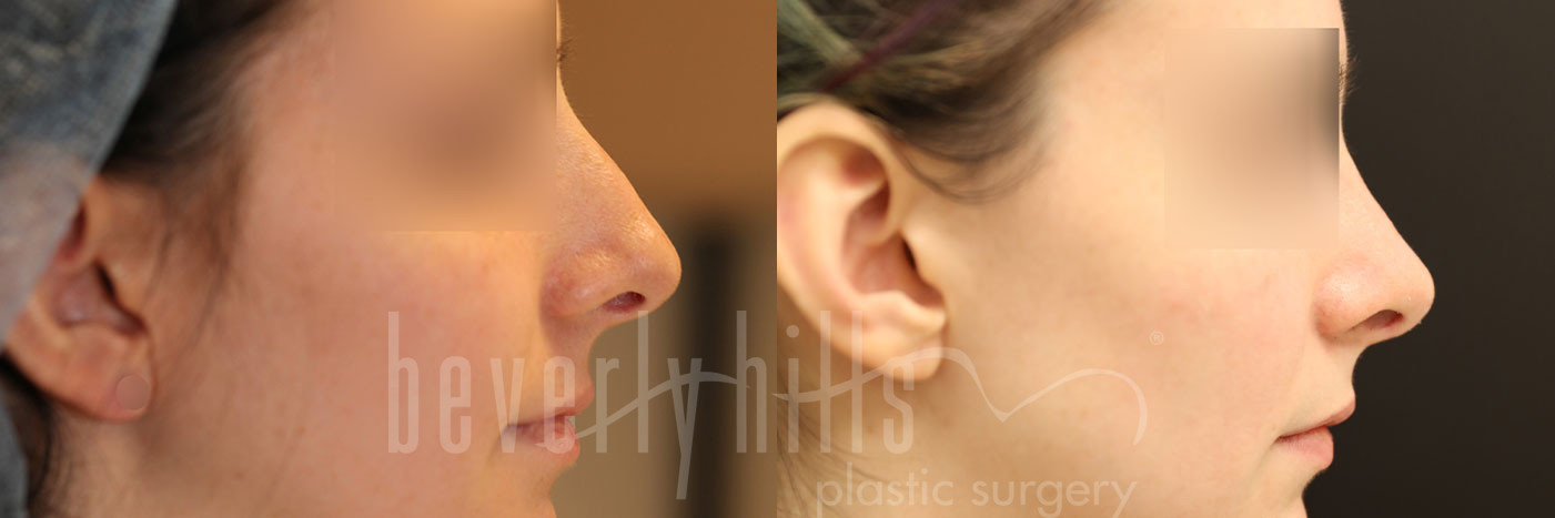 Rhinoplasty 30 Before & After
