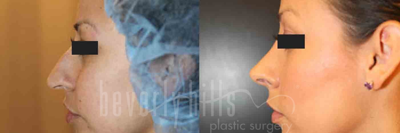 Rhinoplasty Patient 06 Before & After
