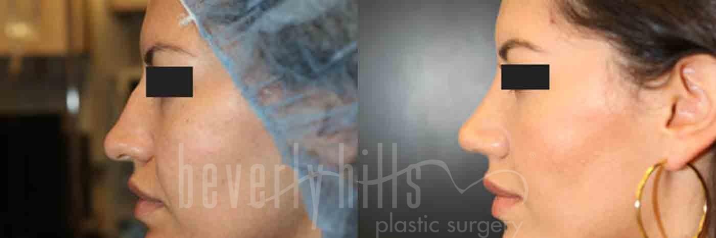 Rhinoplasty Patient 07 Before & After