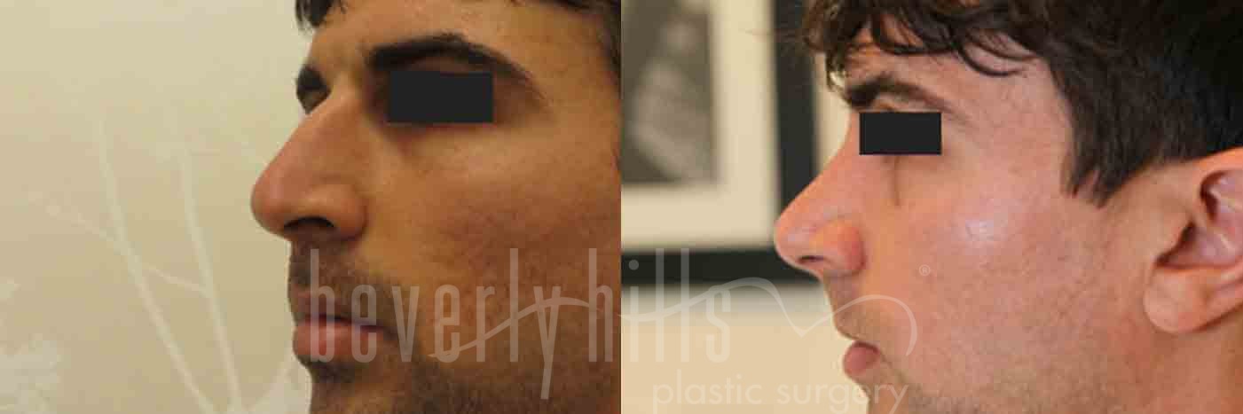 Rhinoplasty Patient 08 Before & After