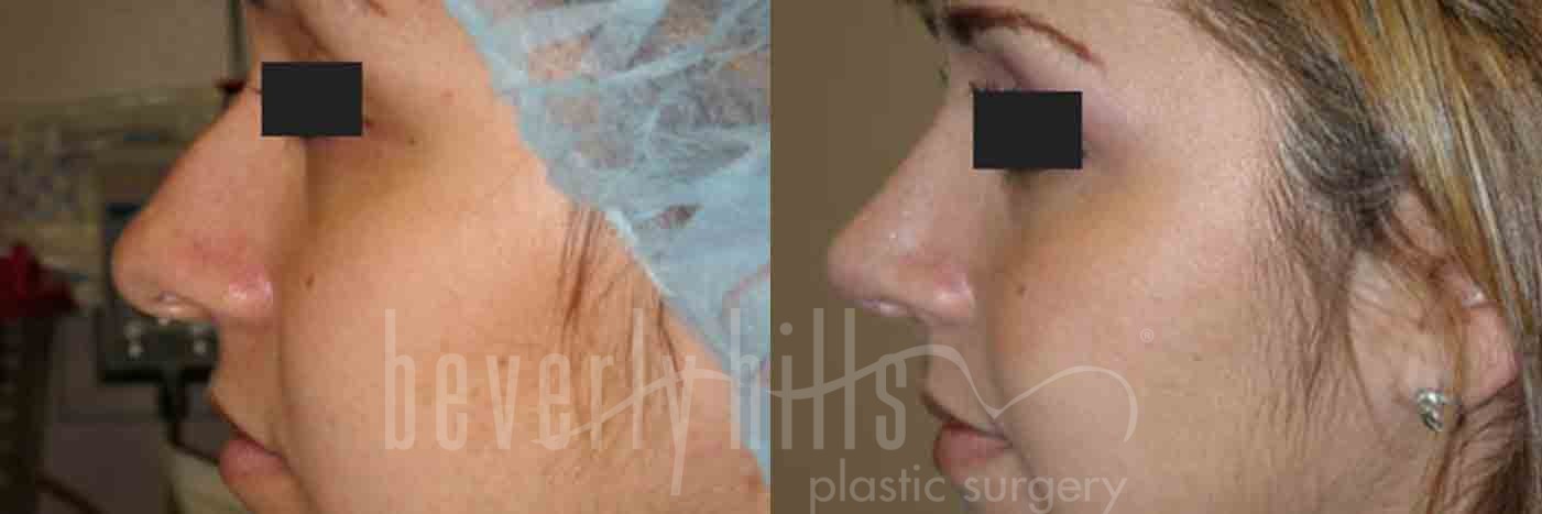 Rhinoplasty Patient 09 Before & After