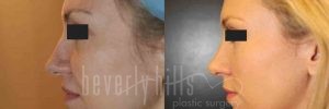 Rhinoplasty Patient 10 Before & After - Thumbnail