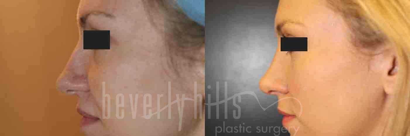 Rhinoplasty Patient 10 Before & After