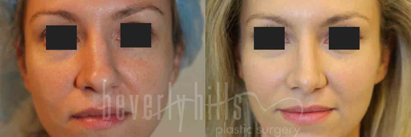 Rhinoplasty Patient 10 Before & After