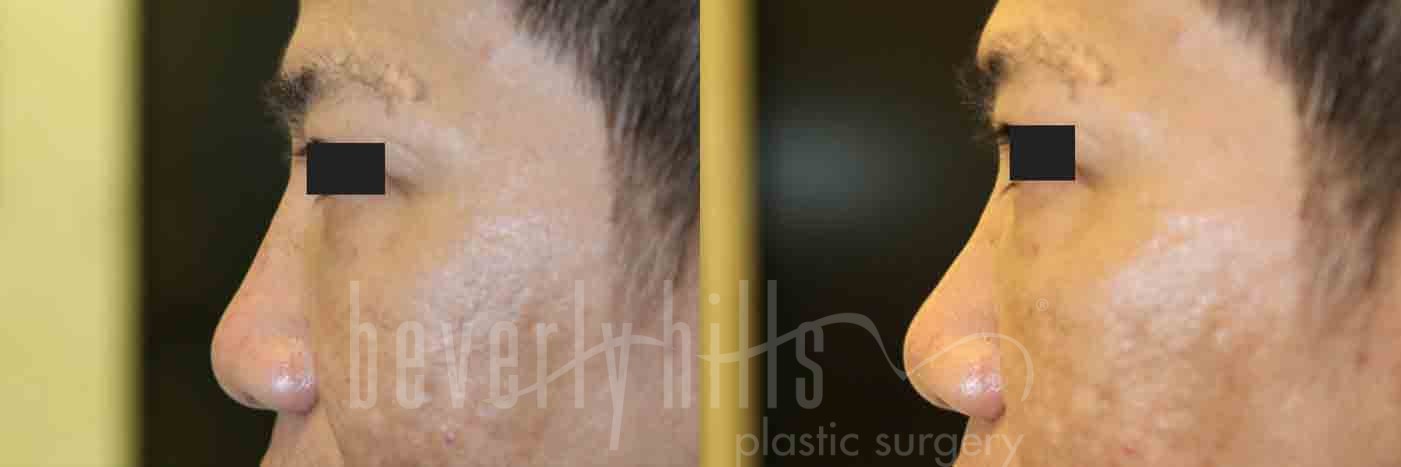 Rhinoplasty Patient 11 Before & After