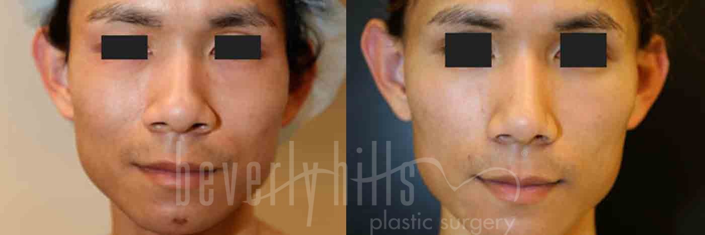 Rhinoplasty Patient 12 Before & After