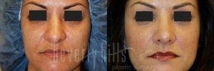 Rhinoplasty Patient 13 Before & After - Thumbnail
