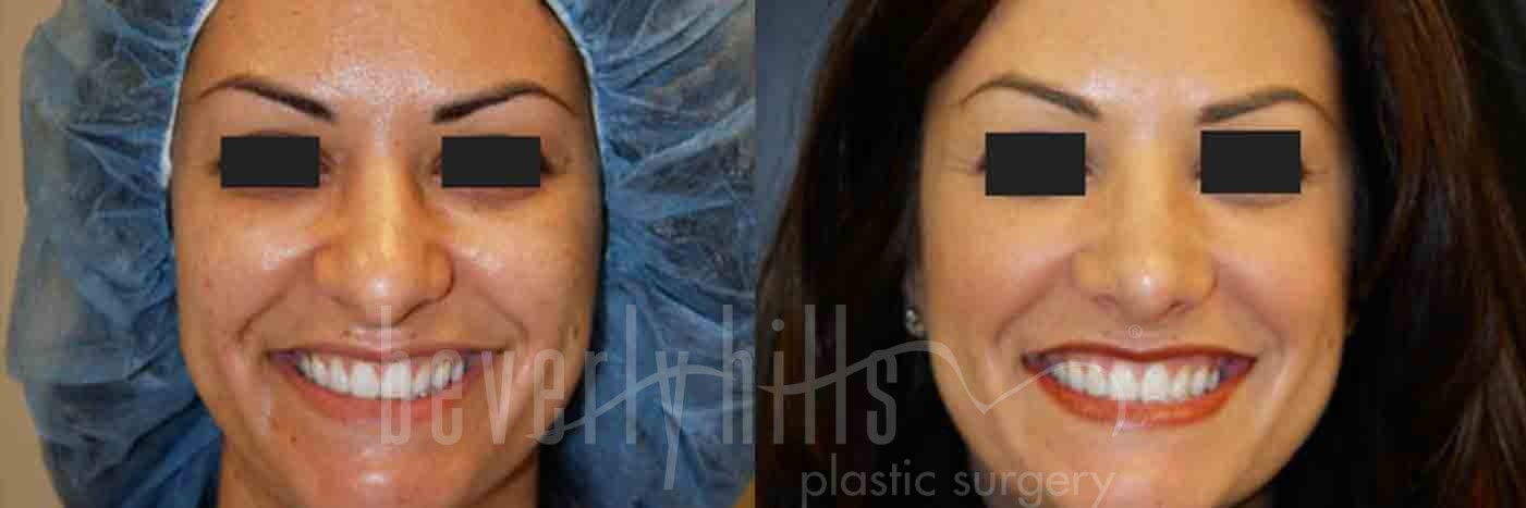 Rhinoplasty Patient 13 Before & After