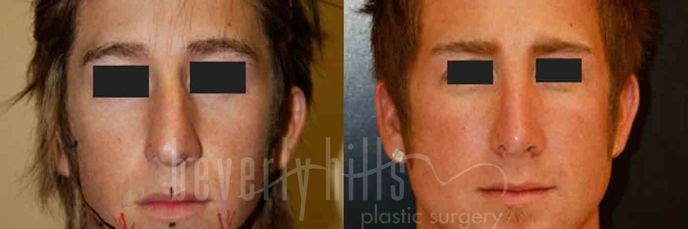 Rhinoplasty Patient 14 Before & After