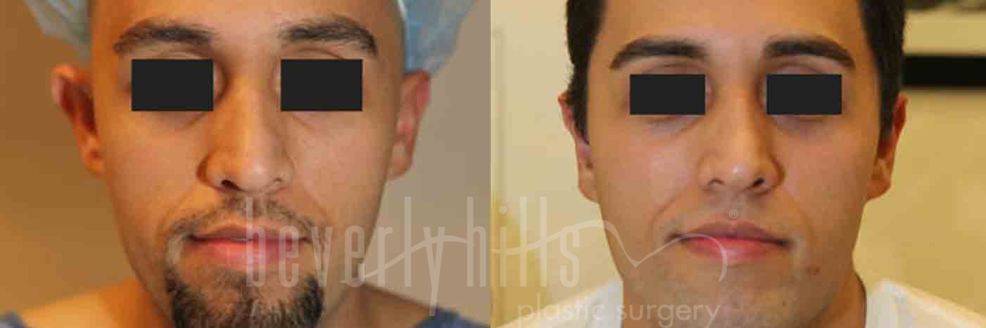 Rhinoplasty Patient 15 Before & After