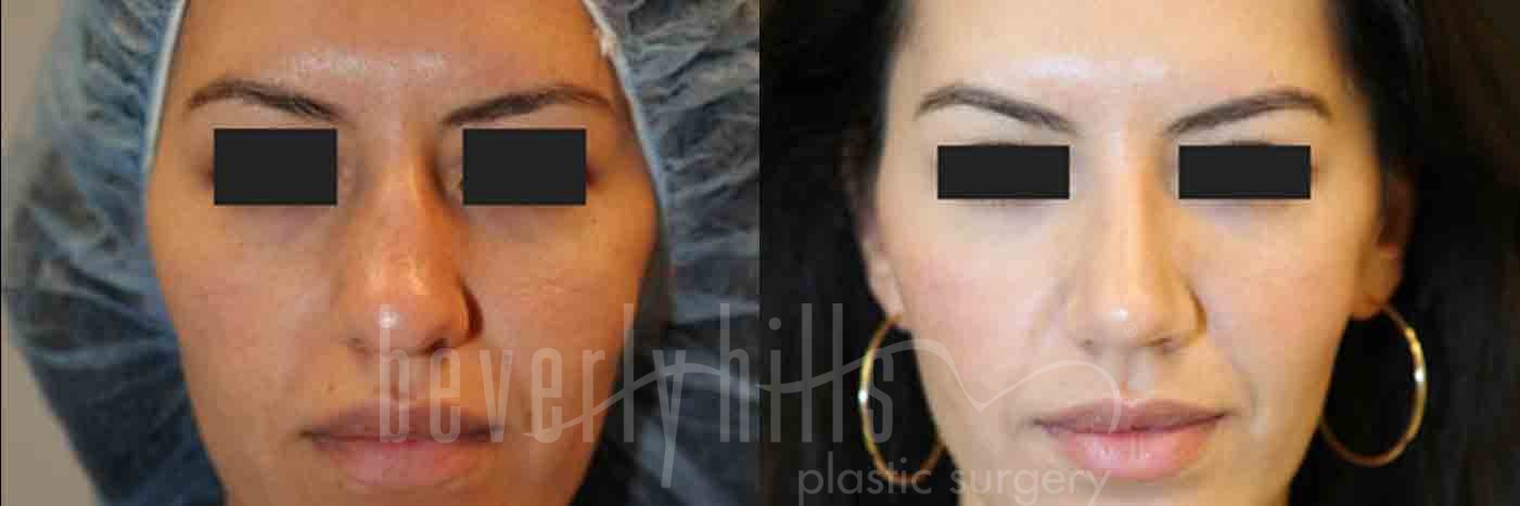 Rhinoplasty Patient 16 Before & After