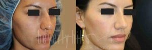 Rhinoplasty Patient 16 Before & After - Thumbnail