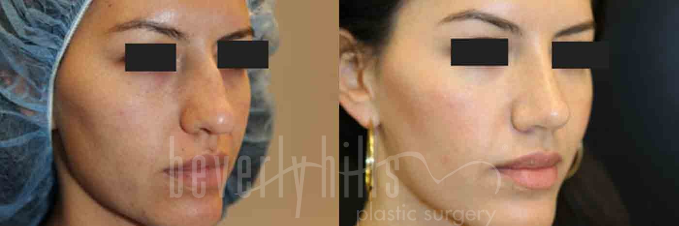 Rhinoplasty Patient 16 Before & After