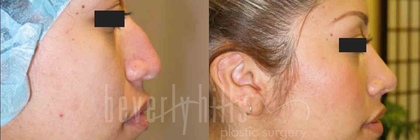 Rhinoplasty Patient 17 Before & After