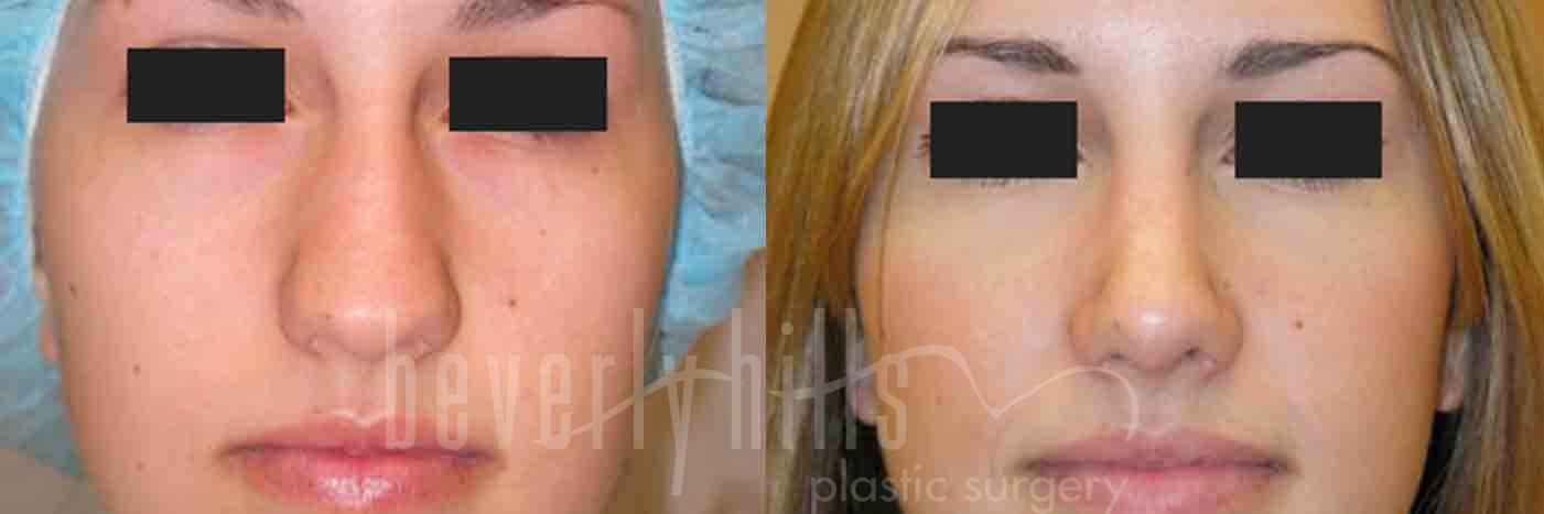 Rhinoplasty Patient 18 Before & After