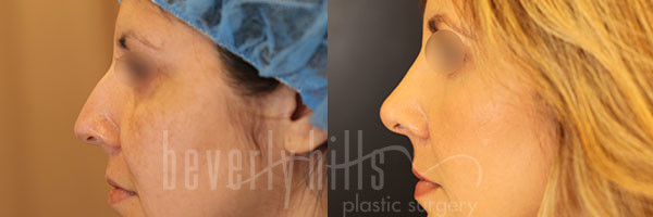 Rhinoplasty Patient 26 Before & After