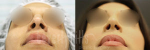 Rhinoplasty Patient 36 Before & After - Thumbnail