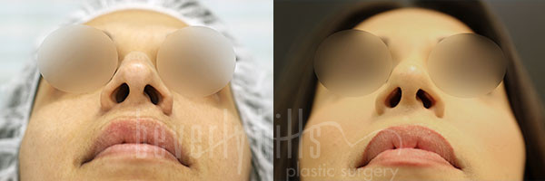 Rhinoplasty Patient 36 Before & After