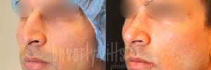 Rhinoplasty Patient 35 Before & After - Thumbnail