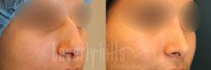 Rhinoplasty Patient 34 Before & After - Thumbnail