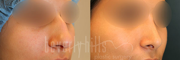 Rhinoplasty Patient 34 Before & After