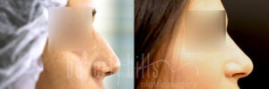 Rhinoplasty Patient 36 Before & After - Thumbnail