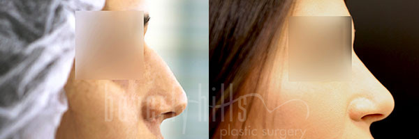 Rhinoplasty Patient 36 Before & After