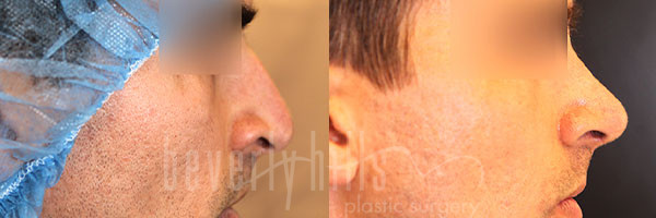 Rhinoplasty Patient 35 Before & After