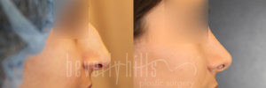 Rhinoplasty Patient 34 Before & After - Thumbnail