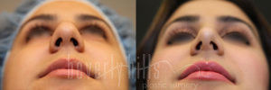Rhinoplasty Patient 29 Before & After - Thumbnail