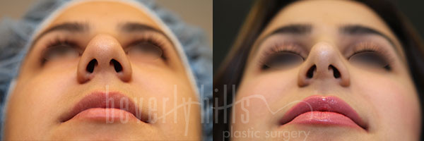 Rhinoplasty Patient 29 Before & After
