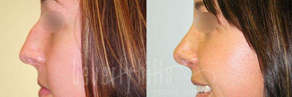 Rhinoplasty Patient 28 Before & After