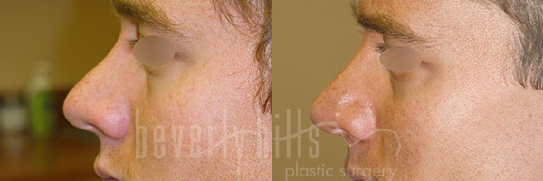 Rhinoplasty Patient 30 Before & After
