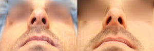 Rhinoplasty Patient 33 Before & After - Thumbnail