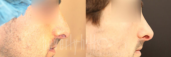 Rhinoplasty Patient 33 Before & After