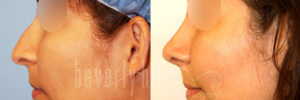 Rhinoplasty Patient 37 Before & After - Thumbnail