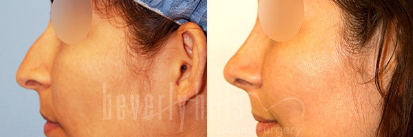 Rhinoplasty Patient 37 Before & After