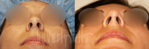 Rhinoplasty Patient 37 Before & After - Thumbnail