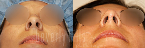 Rhinoplasty Patient 37 Before & After