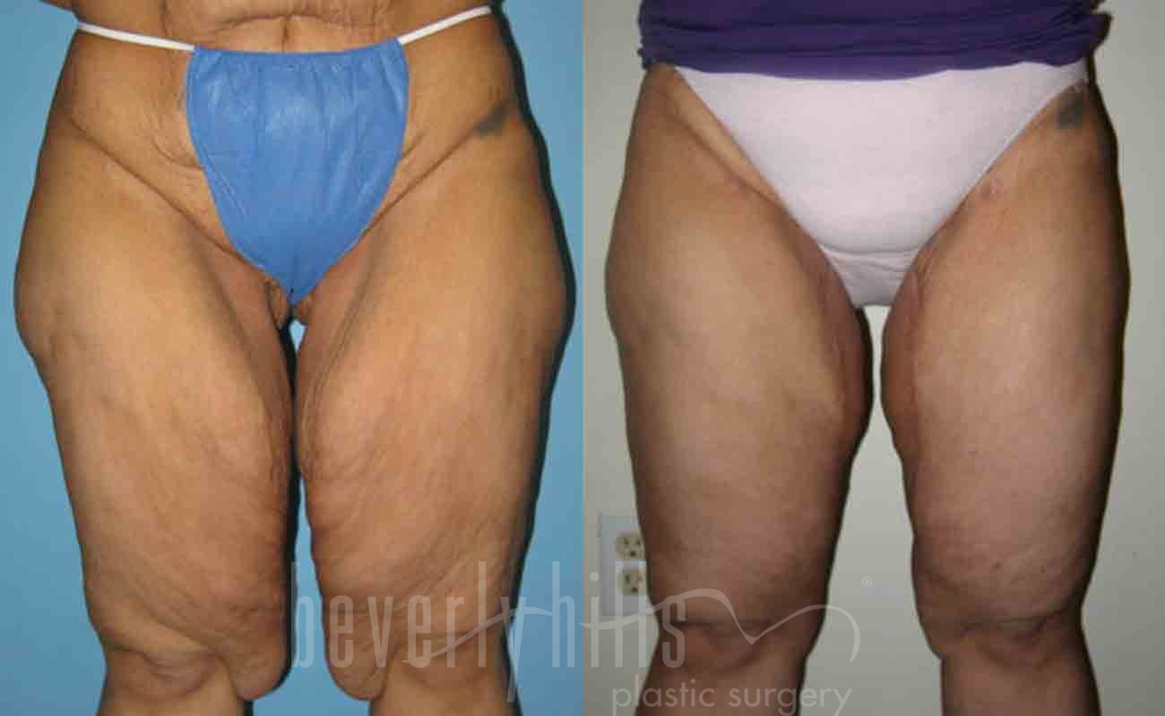 Thigh Lift Patient 01 Before & After