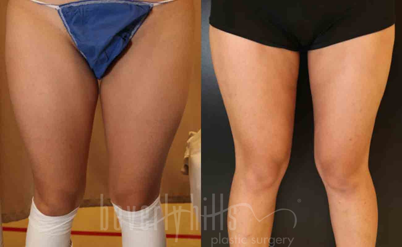 Thigh Lift Patient 02 Before & After