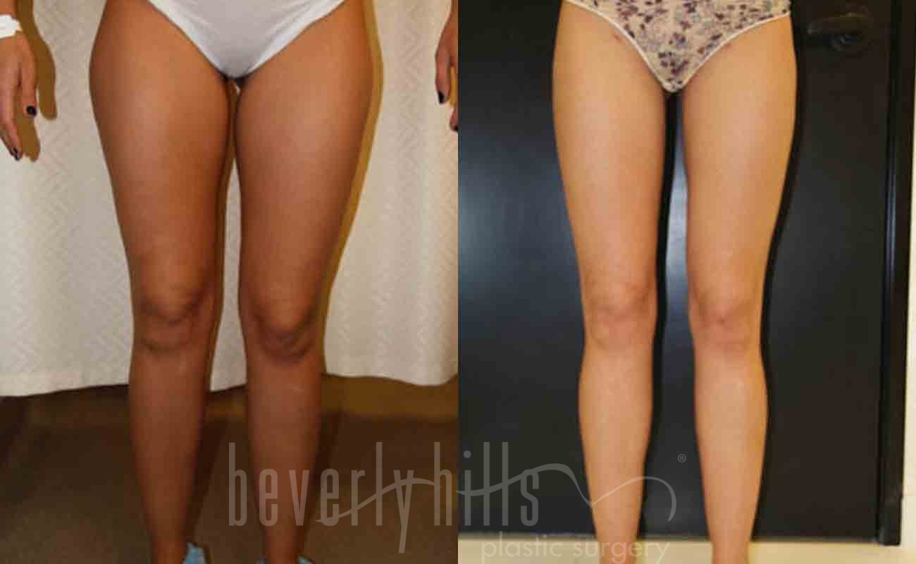 Thigh Lift Patient 03 Before & After