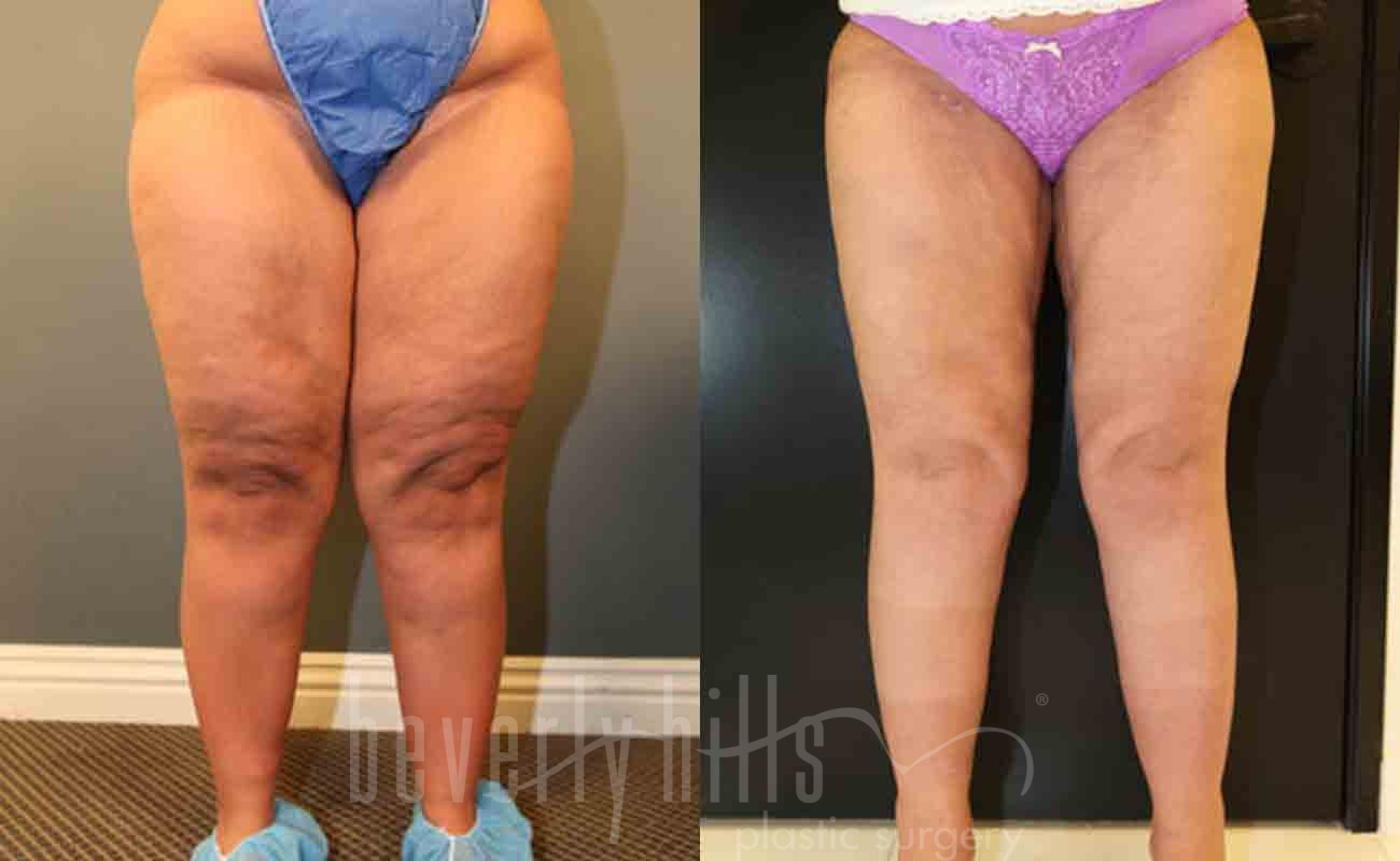 Thigh Lift Patient 04 Before & After
