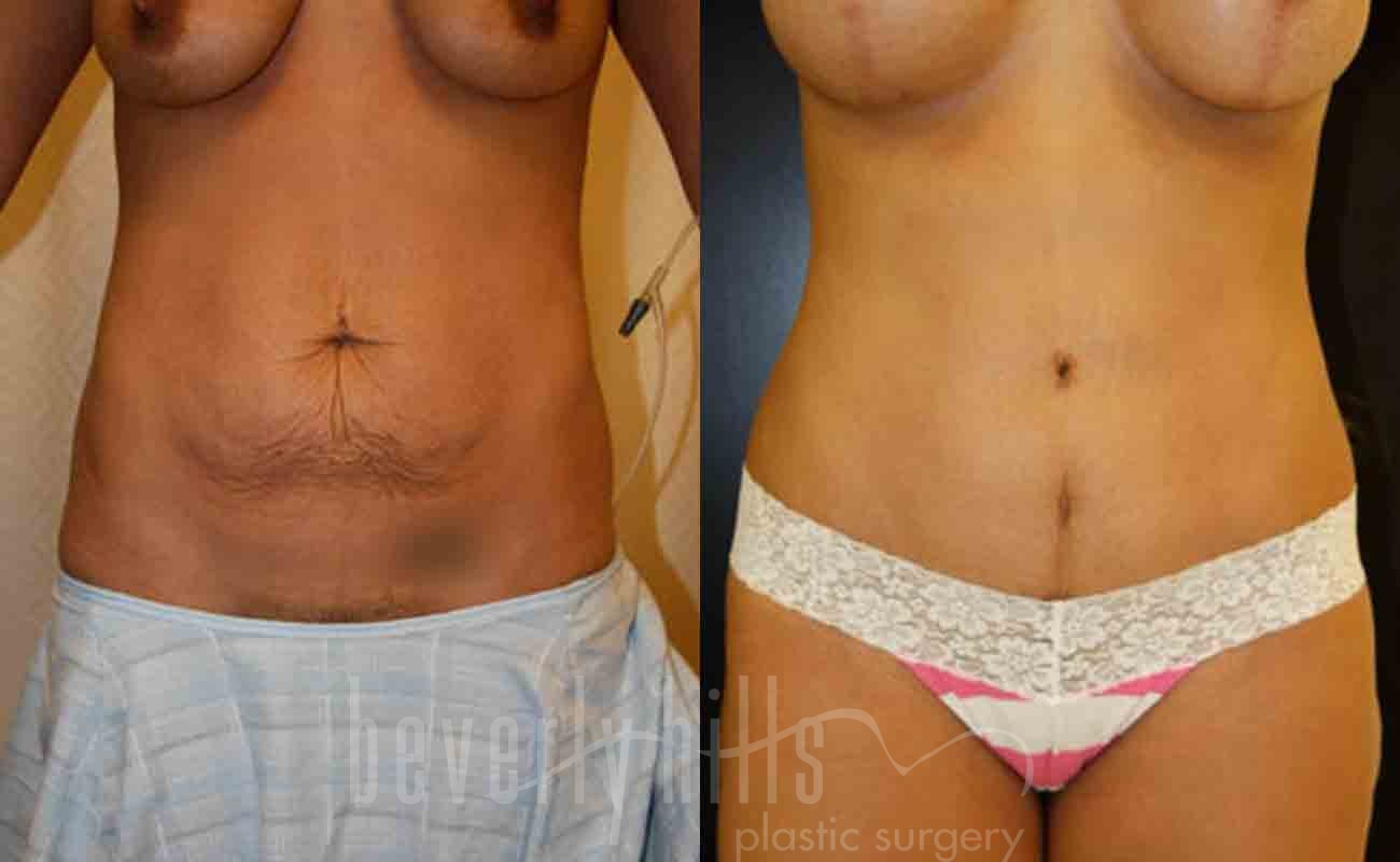 Tummy Tuck Patient 15 Before & After