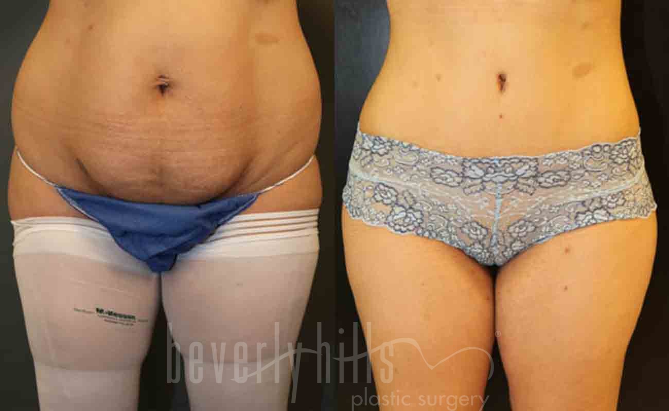 Tummy Tuck Patient 03 Before & After