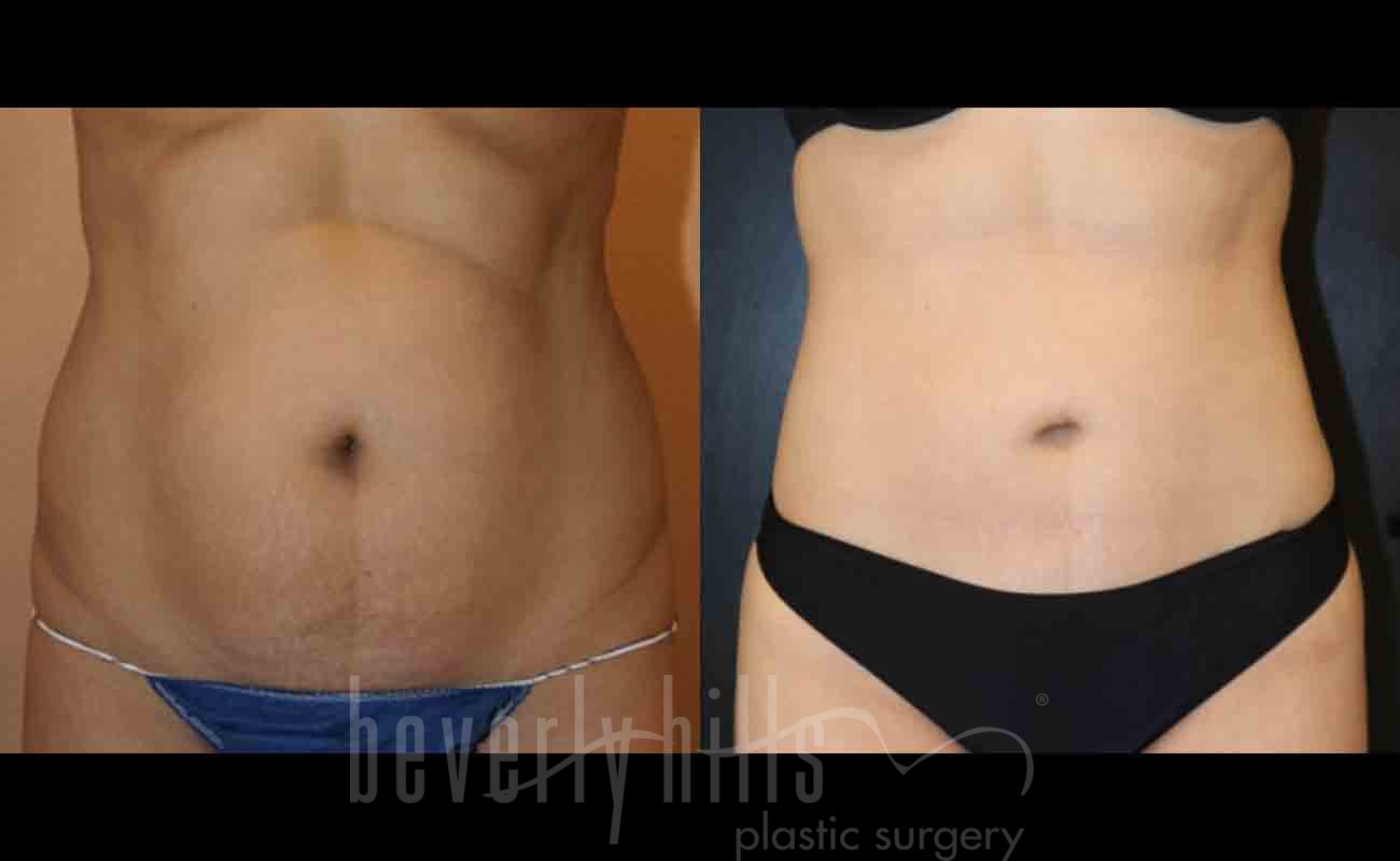 Tummy Tuck Patient 04 Before & After