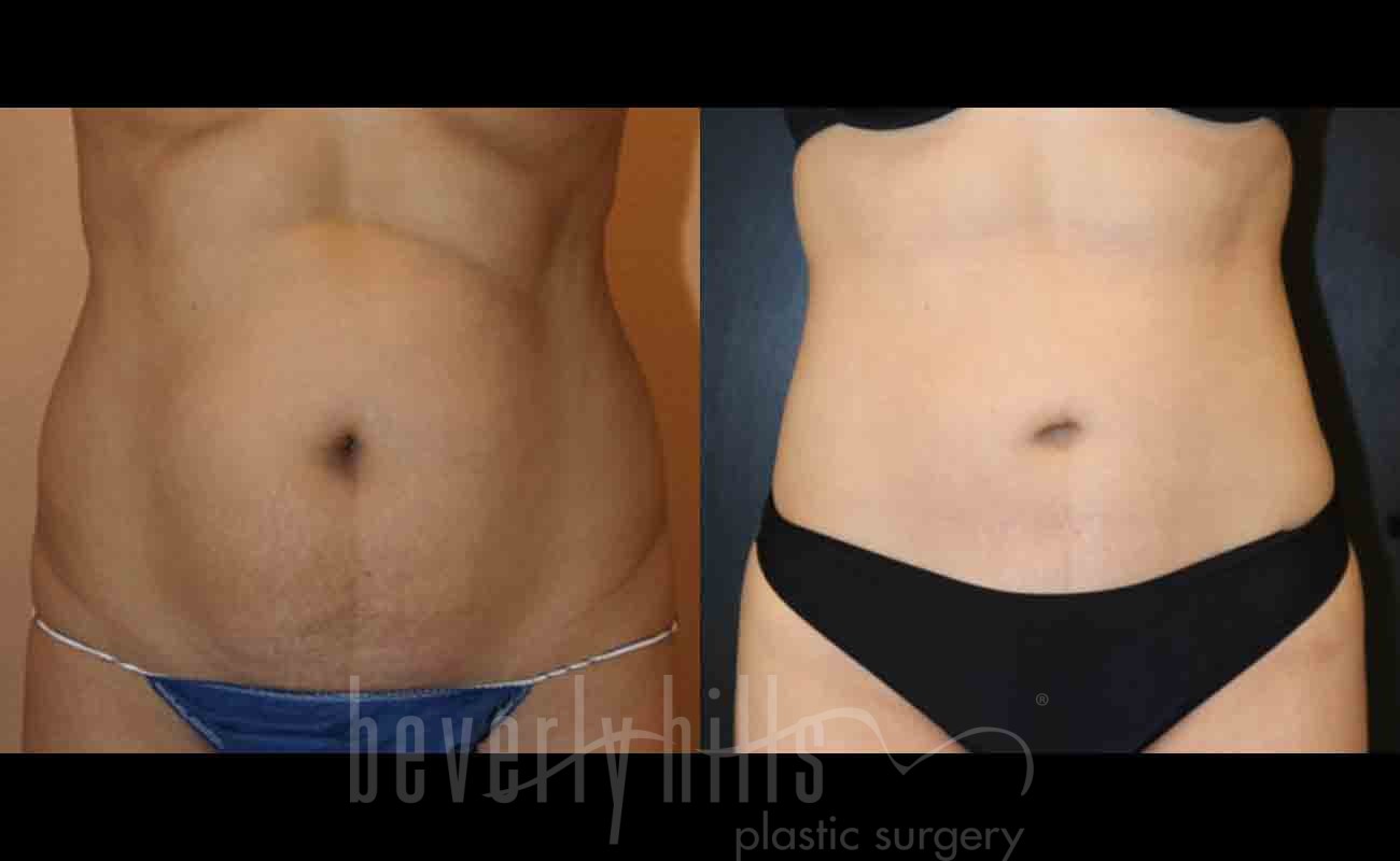 Tummy Tuck Patient 04 Before & After