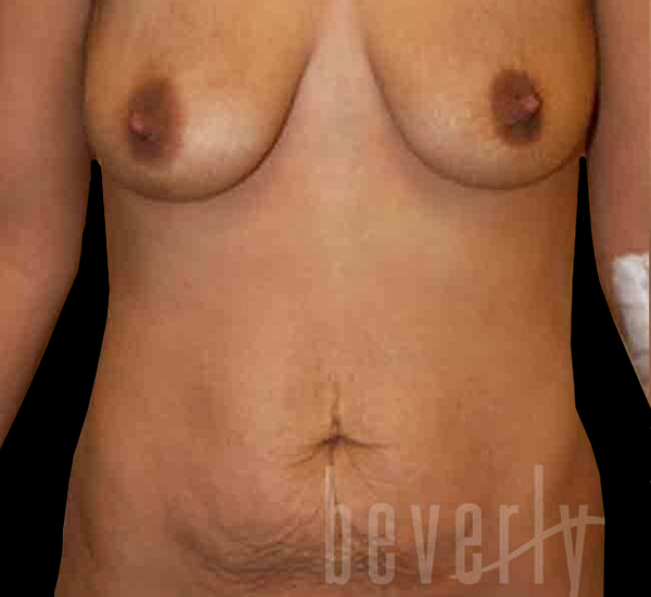 Case--7061 | Before Mommy Makeover