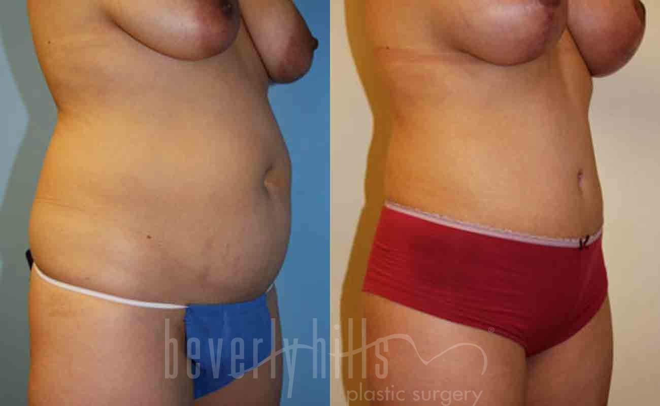 Tummy Tuck Patient 05 Before & After