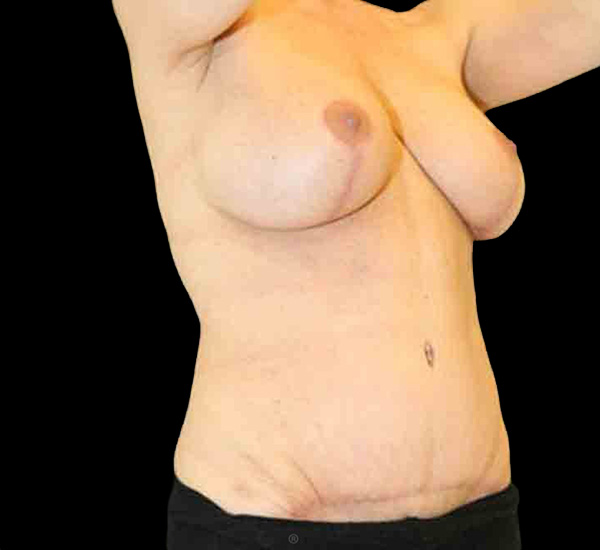 Case--7806 | After Mommy Makeover 2